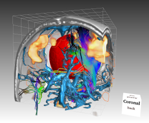 Visualisierung mit der Software Voreen. Der unter dem Schdelknochen liegende Tumor (rot) ist von Blutgefen (blau) umgeben. Das fMRT-Signal (funktionale Magnetresonanztomographie, gelb) zeigt motorische Zentren an.