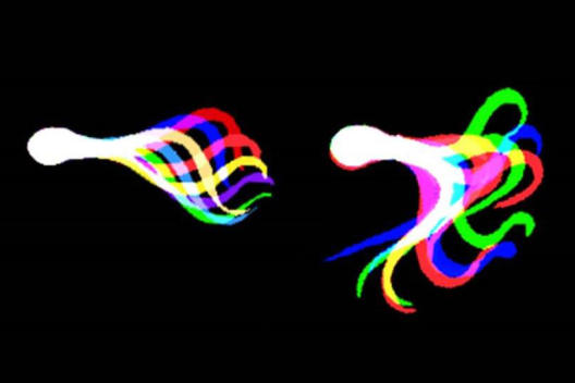 Der Schlagzyklus eines Spermienflagellums im farbcodierten Zeitraffer-Overlay. Patienten-Spermien zeigen im Flagellenschlag eine geringere Amplitude als gesunde Spender-Spermien.