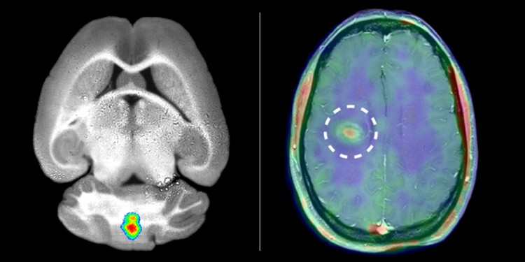 Forscher des Exzellenzclusters "Cells in Motion" machten Entzündungen im Gehirn bei Mäusen (links) und bei Multiple-Sklerose-Patienten (rechts) sichtbar. Dazu markierten sie bestimmte Enzyme (MMPs).<address>© Nachdruck mit Genehmigung des Verlags aus: Gerwien und Hermann et al., Sci. Transl. Med. 8, 364ra152 (2016) 9. November 2016</address>