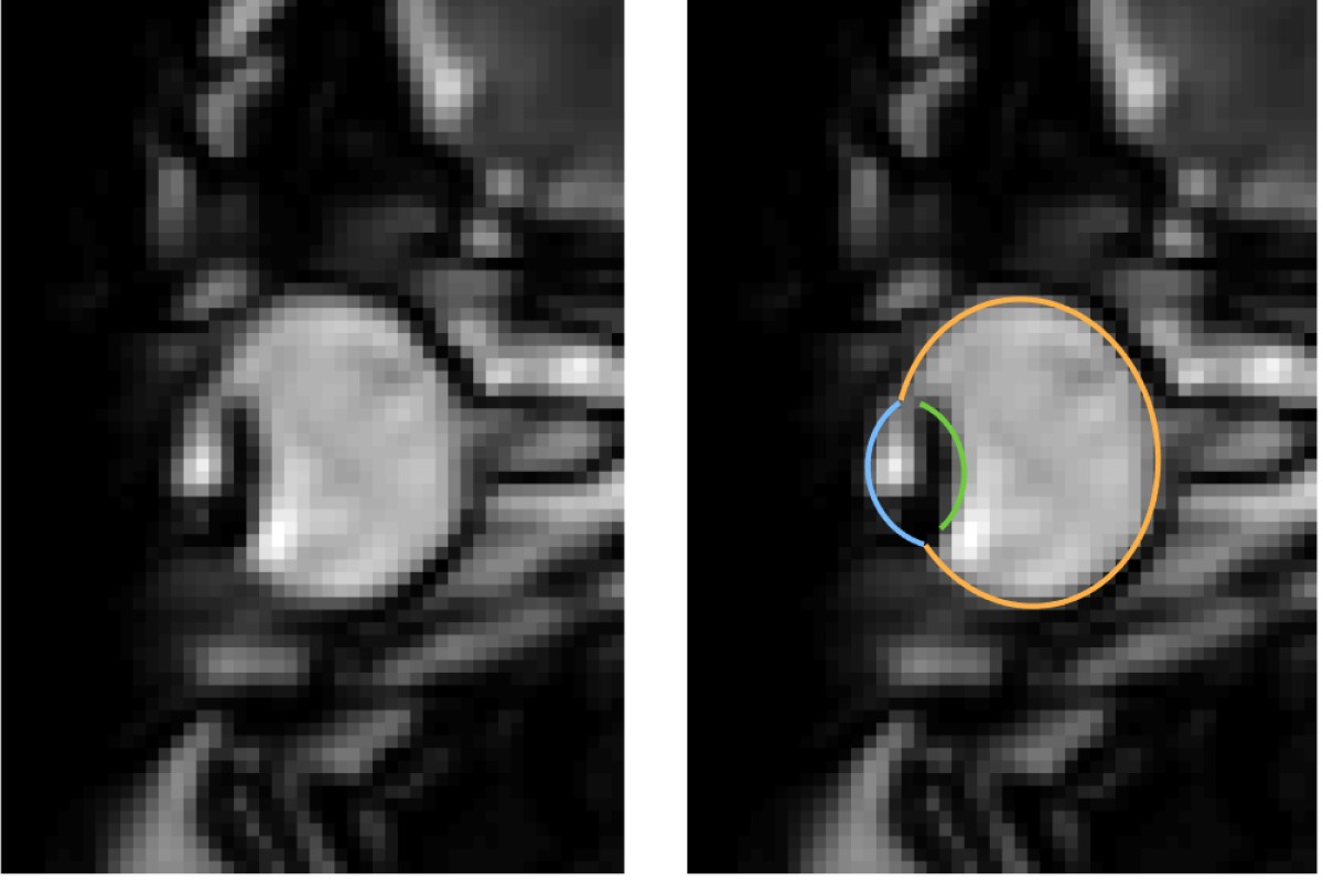 MRI images of eye movements during blinking: The eye is pulled back into the eye socket. The left image shows only the dynamic MRI data, the right image additionally shows the segmentation of the eye by the MREyeTrack. The photo corner consisting of six images shows the eye movement.© WWU - Johannes Kirchner
