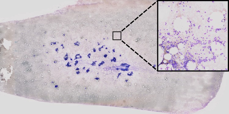 AI-based processing of bone-marrow smears to support leukaemia diagnosis. Using so-called unsupervised learning methods, single-cell images (centre) are extracted from extremely high-resolution image data (left). Then, using neural networks, these cell images are examined to check for any visual anomalies which might have a genetic origin. Areas which are important for the decision of the neural network are highlighted in colour by using so-called “explainable AI” strategies (right).<address>© AG Risse</address>