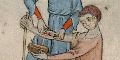 Über Jahrhunderte galt der Aderlass als probates Mittel, um Leiden verschiedenster Art zu behandeln.<address>© Wikipedia, gemeinfrei. Miniatur aus dem Luttrell-Psalter, England, 14. Jahrhundert.</address>