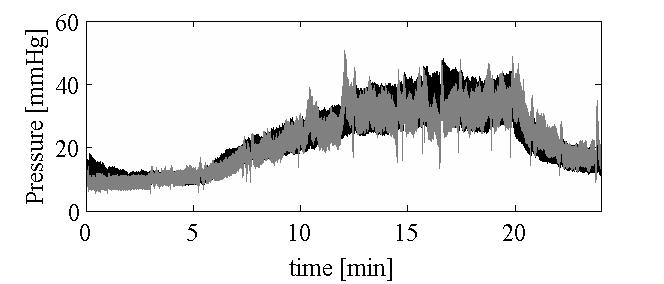 brain pressure during infusion test
