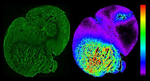 A thin tissue section of a mouse brain with a tumour. Left: Image showing autofluorescence using light microscopy. Right: Distribution of an MRI contrast agent based on the metal gadolinium (concentration increased in the tumour region, green to red), acquired through mass spectrometry – this method provides quantitative information about the contrast agent distribution by detecting the mass of gadolinium. We compare the spatial and temporal distribution of the MRI contrast agent with that of a simultaneously applied and structurally similar PET radiotracer (analysed using autoradiography, not shown). Thereby, we aim to validate newly developed mathematical models for processing dynamic PET-MRI imaging data. (Collaboration of projects B02 and B06)