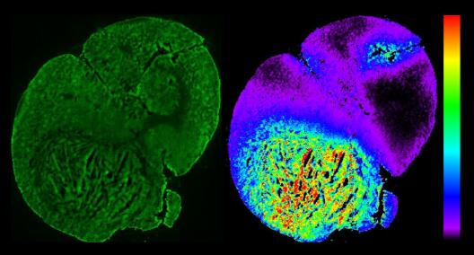 A thin tissue section of a mouse brain with a tumour. Left: Image showing autofluorescence using light microscopy. Right: Distribution of an MRI contrast agent based on the metal gadolinium (concentration increased in the tumour region, green to red), acquired through mass spectrometry – this method provides quantitative information about the contrast agent distribution by detecting the mass of gadolinium. We compare the spatial and temporal distribution of the MRI contrast agent with that of a simultaneously applied and structurally similar PET radiotracer (analysed using autoradiography, not shown). Thereby, we aim to validate newly developed mathematical models for processing dynamic PET-MRI imaging data. (Collaboration of projects B02 and B06)