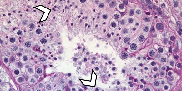 Histology: cross-section of the testicle of a man with normal sperm formation (A) and of a man with M1AP mutation (B). The arrows indicate sperm (white) and the cells from which sperm normally proceeds (yellow/black).<address>© Nadja Rotte</address>