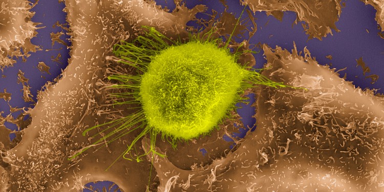 Menschliche Lungenepithel-Krebszellen zwischen gesunden Epithelzellen unter dem Rasterelektronenmikroskop.<address>© Science Photo Library - Dennis Kunkel Microscopy</address>