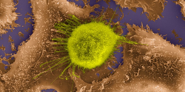 Human lung epithelial cancer cell between healthy epithelial cells under the scanning electron microscop.<address>© Science Photo Library - Dennis Kunkel Microscopy</address>