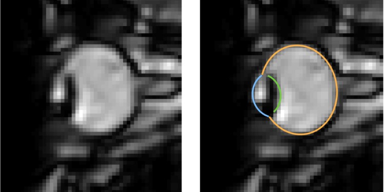 MRI images of eye movements during blinking: The eye is pulled back into the eye socket. The left image shows only the dynamic MRI data, the right image additionally shows the segmentation of the eye by the MREyeTrack. The photo corner consisting of six images shows the eye movement.<address>© WWU - Johannes Kirchner</address>