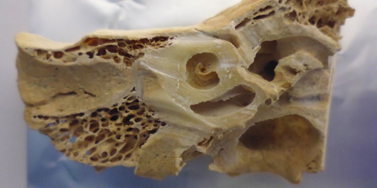 Anhand alter Knochen - hier das Felsenbein im Innenohr - untersucht Ron Pinhasi die Evolution des Menschen.<address>© Ron Pinhasi</address>
