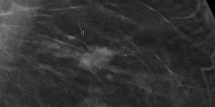 Das Bild zeigt eine medizinische Schichtaufnahme der Brust. Ein Pfeil zeigt auf eine erkennbare Struktur.<address>&copy; Referenzzentrum Mammographie Münster</address>