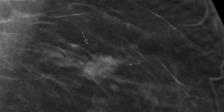 The image shows a slice of a digital breast tomosynthesis examination. An arrow points to a structural distortion.<address>&copy; Referenzzentrum Mammographie Münster</address>
